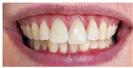 Teeth Whitening - Dr. Michael’s Dental Clinics