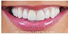 Braces and Veneers - Dr. Michael’s Dental Clinics