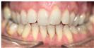 Dental Braces - Dr. Michael’s Dental Clinics