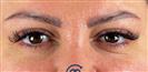Eyelid Surgery - Клиника Cayra
