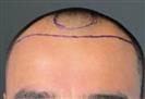 FUE Hair Transplant - Клиника Cayra