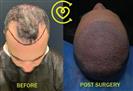 FUE Hair Transplant - Клиника Cayra