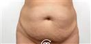 Liposuction - Клиника Cayra