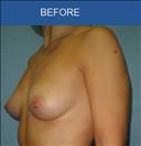 Breast Implants - Клиника Cirumed