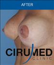 Breast Lift - Клиника Cirumed