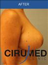 Breast Lift - Клиника Cirumed