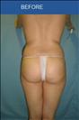 Brazilian Butt Lift - Клиника Cirumed