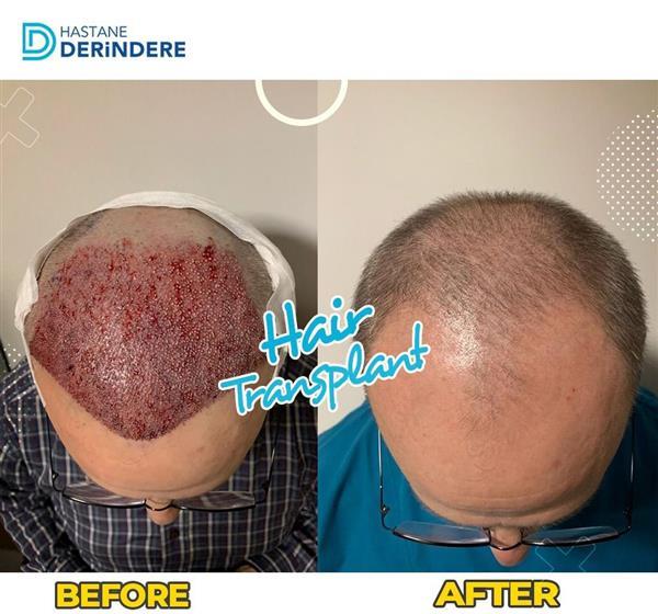 Hair Transplant