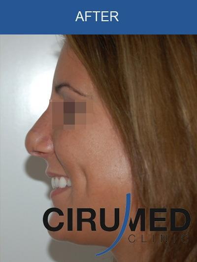 Rhinoplasty
